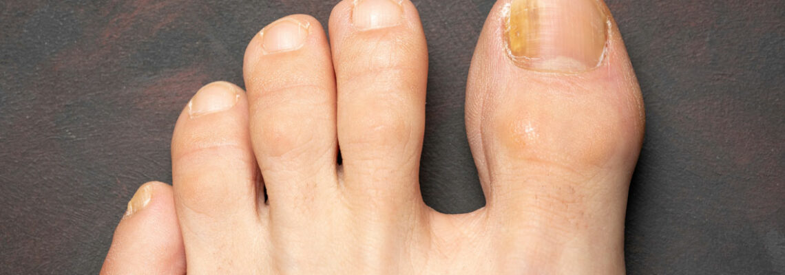 Fungal Nail Infections